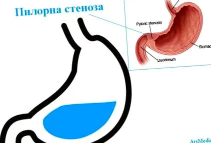 pylorus stenosis pylorus