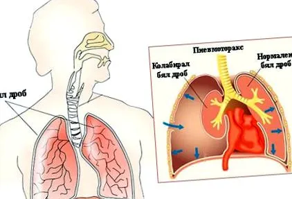 tünetek pneumothorax levegő