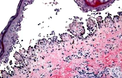 pemphigus pemphigus