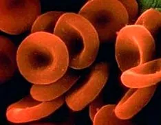 Alacsony hemoglobin