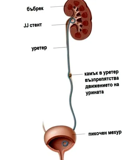 elhelyezése ureterben