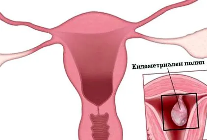 polipok endometrium
