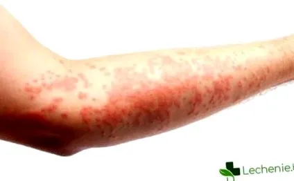 típusú neurofibromatosis neurofibromatosis