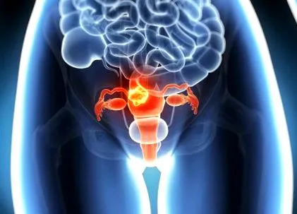 méhrák endometrium