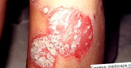 psoriasis