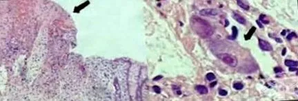 colitis colitis