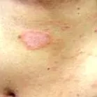 asya rózsahámlás