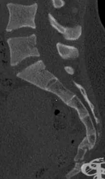 coccyx coccyx