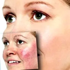 rosacea táplálkozás