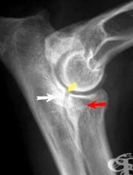 felső ulna felső
