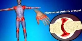 rheumatoid boryan