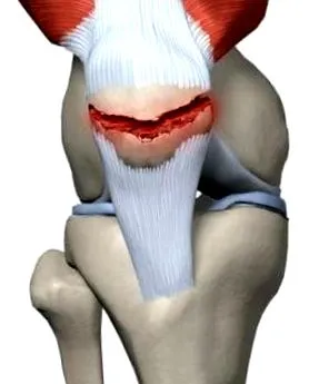 patella patella törése