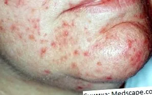 rosacea kezelés