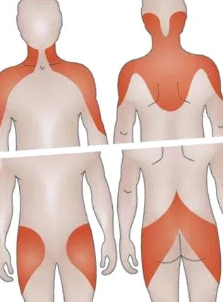 polymyalgia