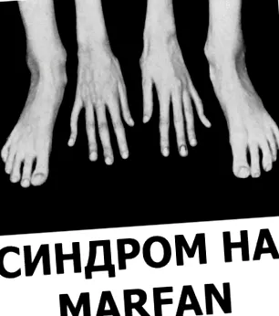 petefészek szindróma tünetei petefészek szindróma