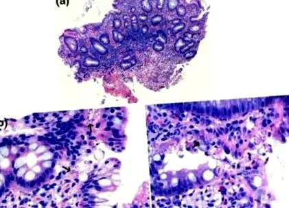 staphylococcus patológia