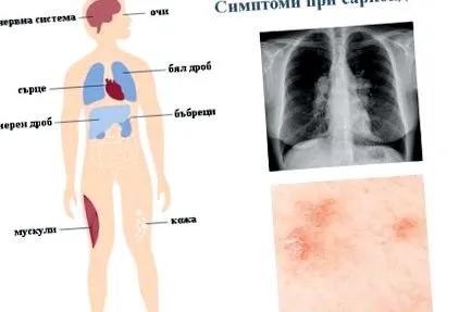 tünetei szarkoidózis