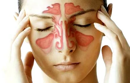 sinusitis kezelés