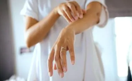 psoriasis
