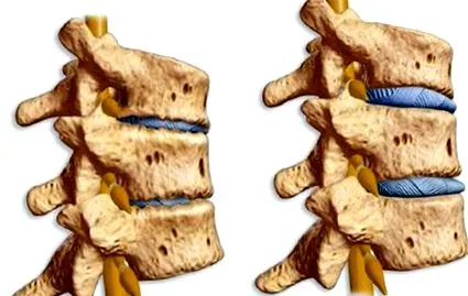 tünetek kezelés spondyloarthritis