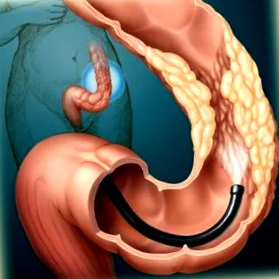 hasi membrán ileus