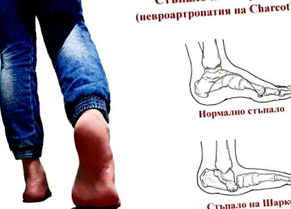 Charcot lábának