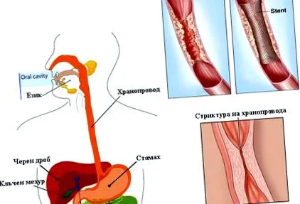 nyelőcső nyelőcső szűkületének