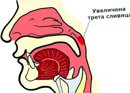 harmadik mandula megnagyobbodott