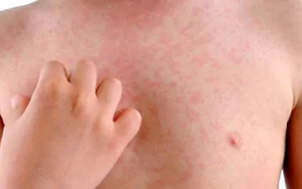 urticaria urticaria