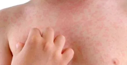 allergénnel