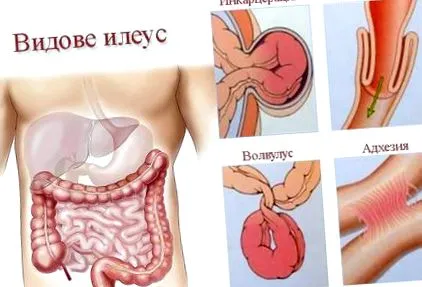 ileus típusai