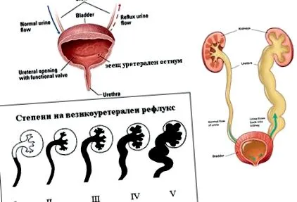 gyermekeknél vesicoureteralis