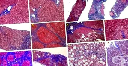 cirrhosis patológia