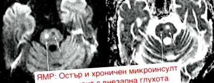 között halláscsökkenés