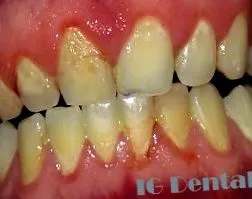 dental parodontium