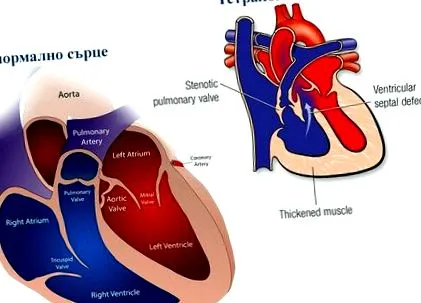 aorta pulmonalis