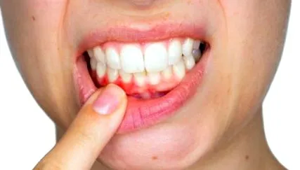 gingivitis kezelések