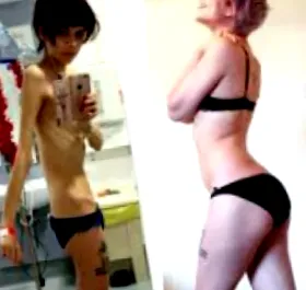 anorexia