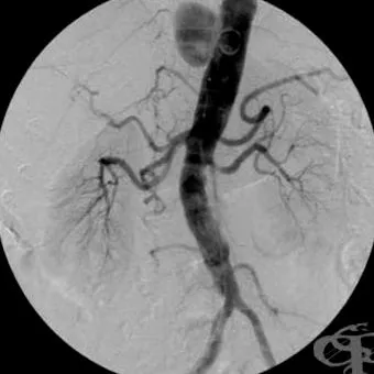 ateroszklerotikus plakk aorta érelmeszesedése