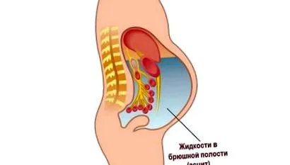 mint ascites