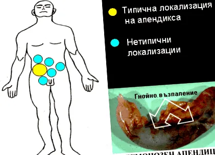 kezelés vakbélgyulladás