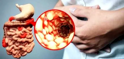 Crohn-betegségben szenvedő