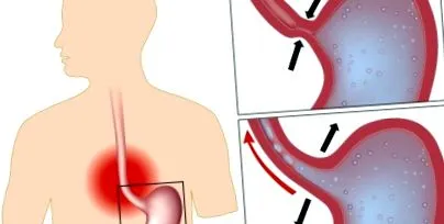 oesophagitis oesophagitis