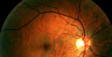 retinopathia diabéteszes