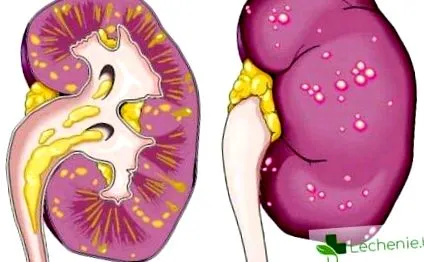 pyelonephritis
