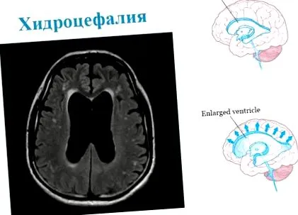 cerebrospinális folyadék hydrocephalus