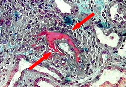 wegener Wegener granulomatosis