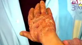 pellagra pellagra