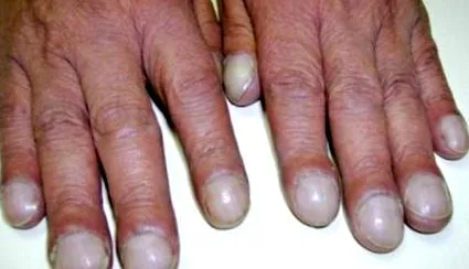 hyperostosis ízületi