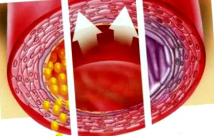 diszlipidémia